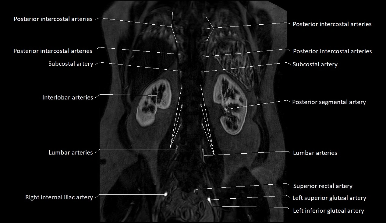 MRA Abdomen coronal anatomy image 45.webp